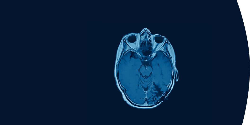 Hirntumortherapie Für Glioblastom & Astrozytom Grad 4 | Optune.de